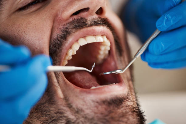 Emergency Dental Filling Replacement in TN